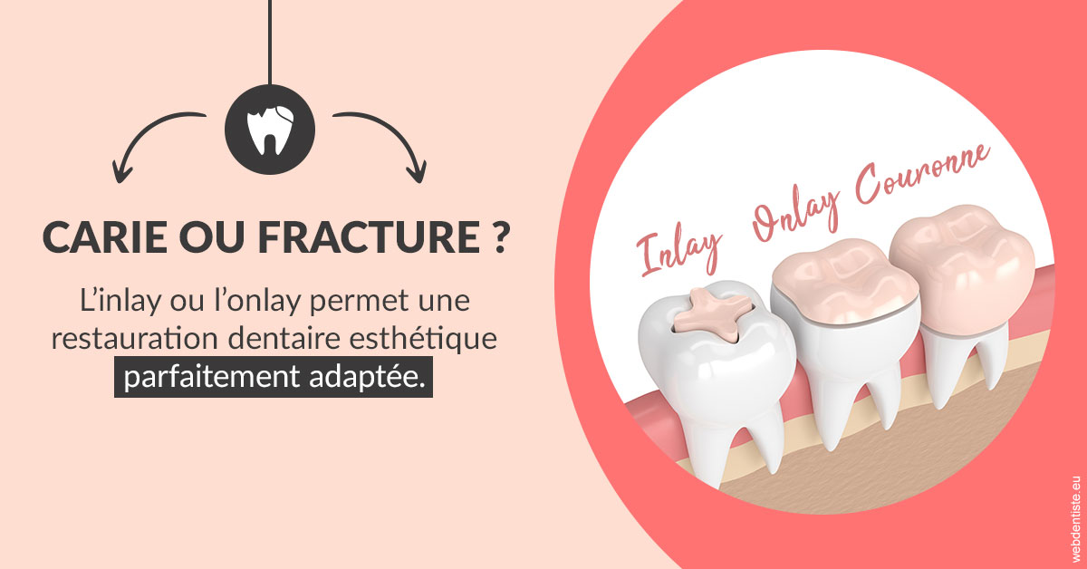 https://www.dentistesbeal.fr/T2 2023 - Carie ou fracture 2