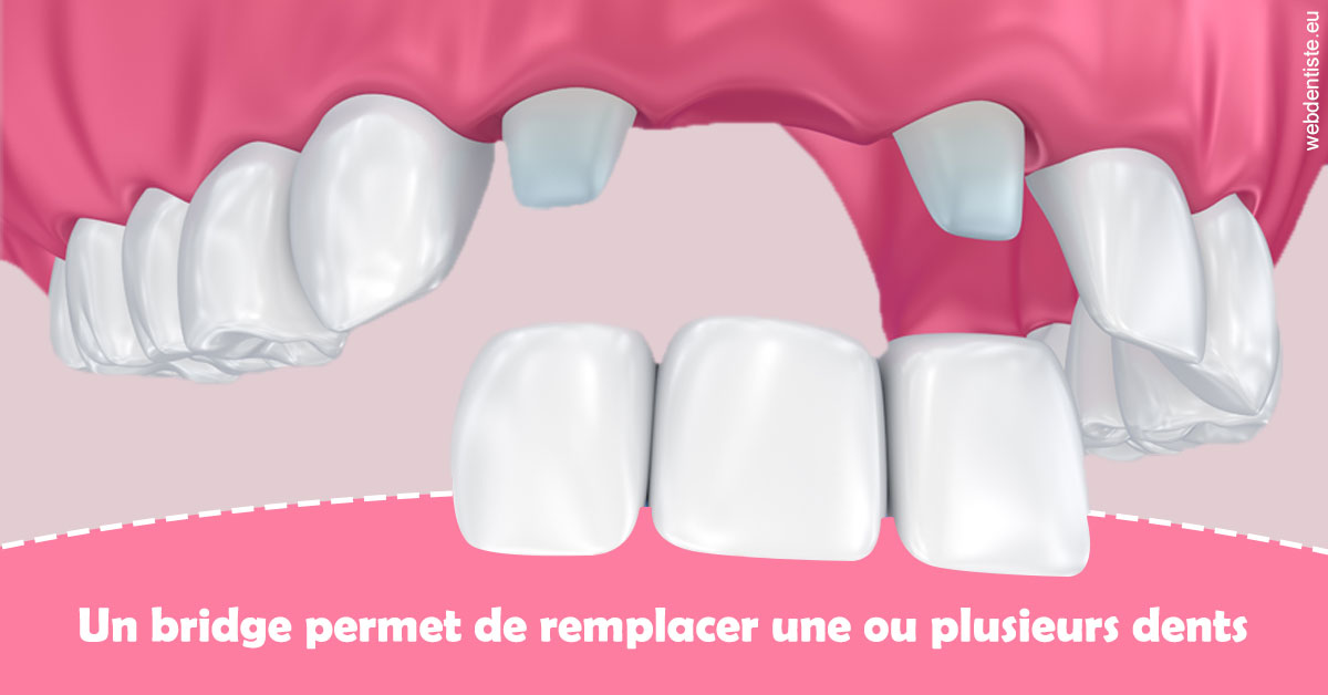 https://www.dentistesbeal.fr/Bridge remplacer dents 2