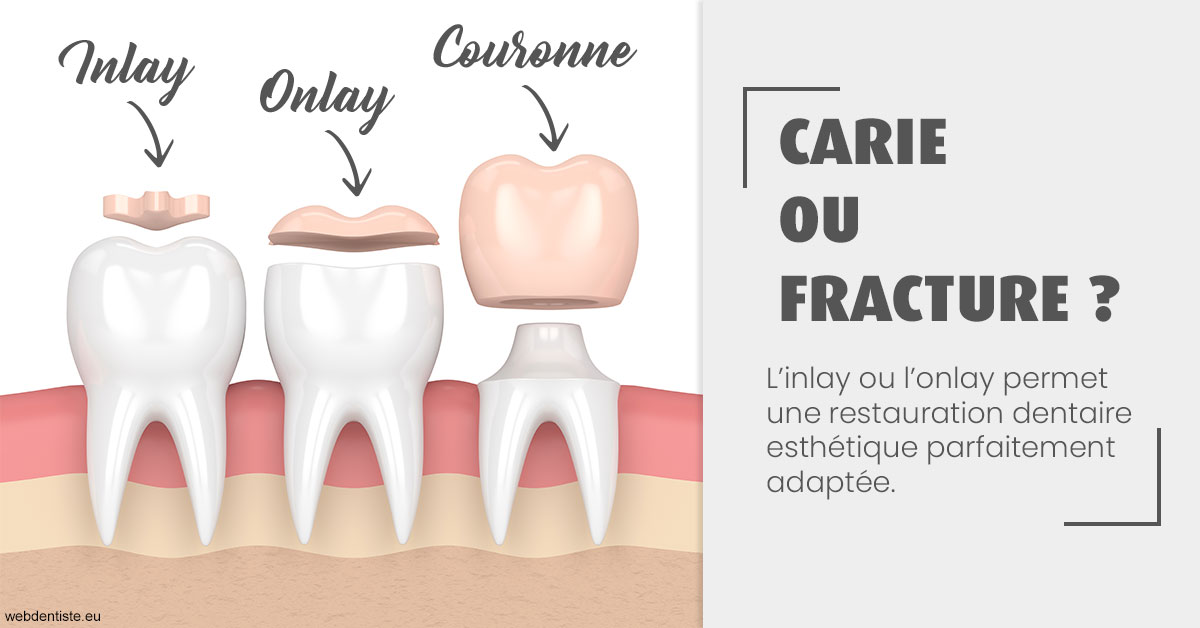 https://www.dentistesbeal.fr/T2 2023 - Carie ou fracture 1