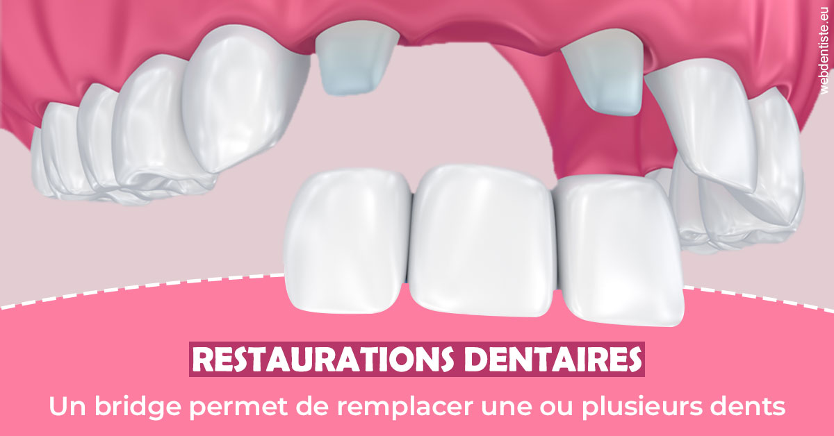 https://www.dentistesbeal.fr/Bridge remplacer dents 2