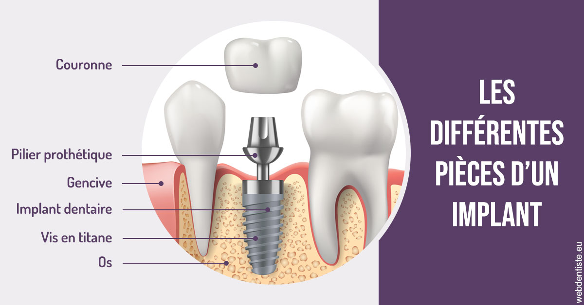 https://www.dentistesbeal.fr/Les différentes pièces d’un implant 2