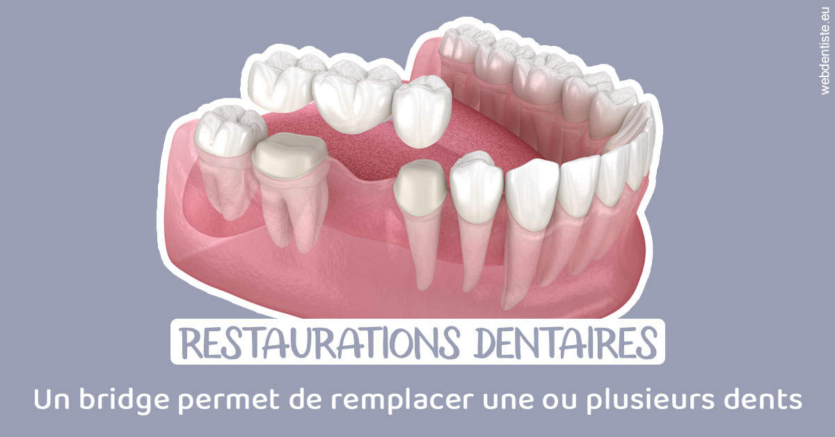 https://www.dentistesbeal.fr/Bridge remplacer dents 1