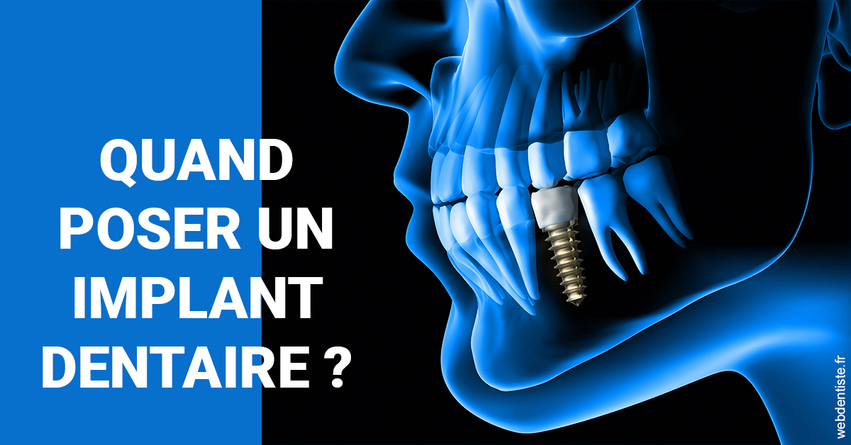 https://www.dentistesbeal.fr/Les implants 1