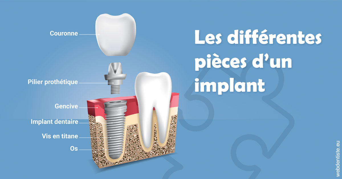 https://www.dentistesbeal.fr/Les différentes pièces d’un implant 1