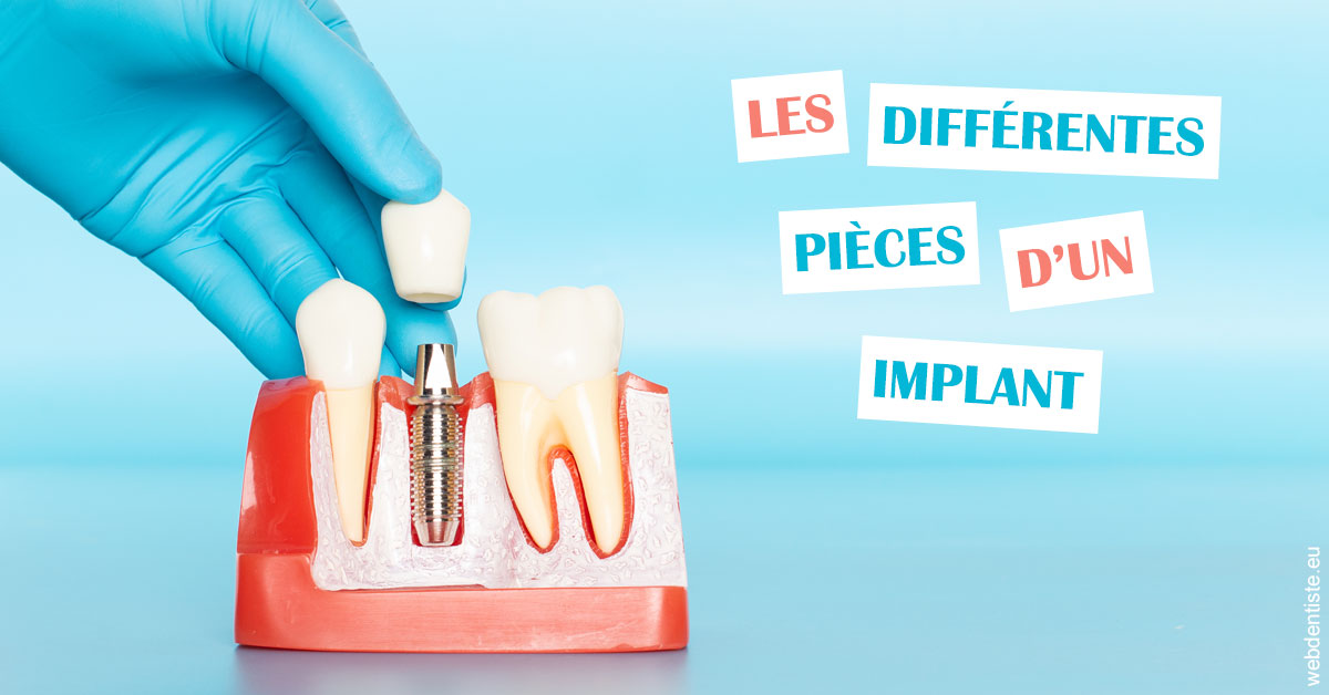 https://www.dentistesbeal.fr/Les différentes pièces d’un implant 2