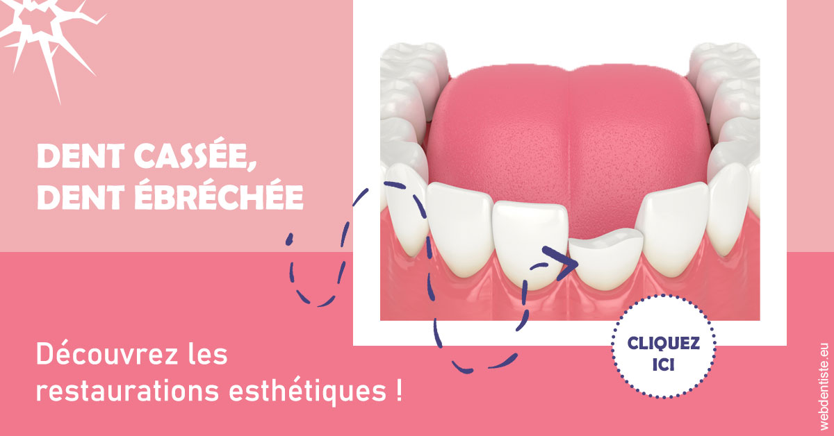 https://www.dentistesbeal.fr/Dent cassée ébréchée 1